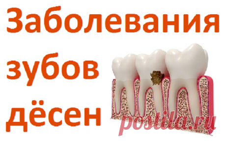 Заболевания зубов, дёсен и народные средства при зубной боли | Советы целительницы