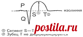 • ЭКГ признаки инфаркта миокарда - Шпаргалки для 