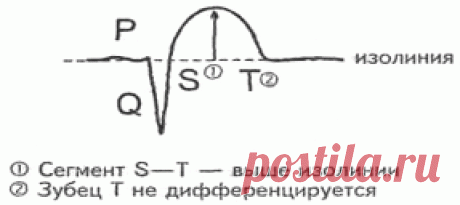 • ЭКГ признаки инфаркта миокарда - Шпаргалки для "скорой помощи"