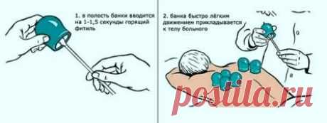 Лечение банками. Как правильно поставить банки