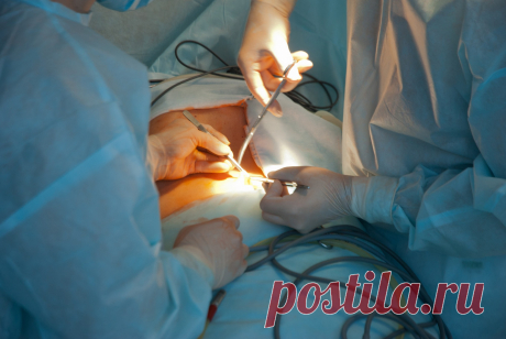 Рукавная гастропластика | Хирургическое лечение опасных форм ожирения.