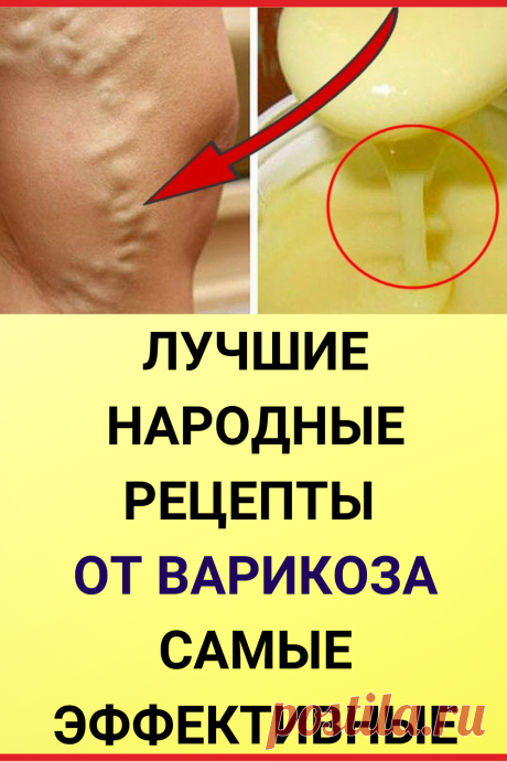 Лучшие народные рецепты от варикоза - самые эффективные народные средства!
