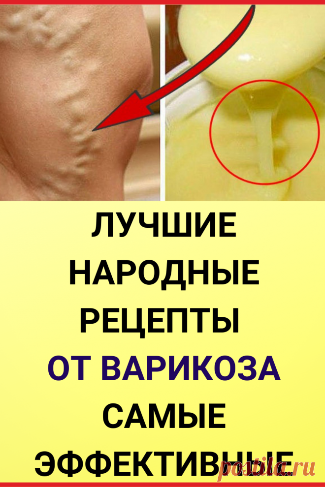Лучшие народные рецепты от варикоза - самые эффективные народные средства!