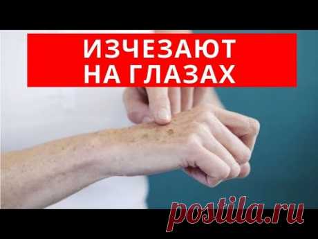 ДЕШЕВОЕ сильнодействующее СРЕДСТВО от ПИГМЕНТНЫХ ПЯТЕН