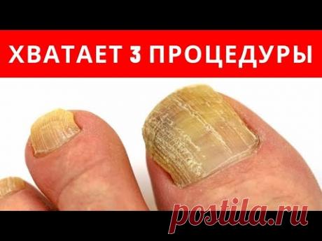 ХВАТАЕТ 3-х ПРОЦЕДУР от ГРИБКА НОГТЕЙ