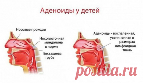 Простые советы как избавиться от аденоидов / Будьте здоровы