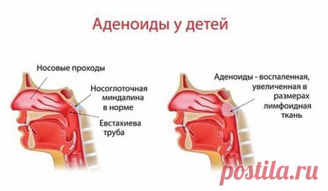 Простые советы как избавиться от аденоидов / Будьте здоровы