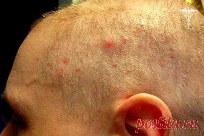 язвочки на голове у мужчин в волосах: 5 тыс изображений найдено в Яндекс.Картинках