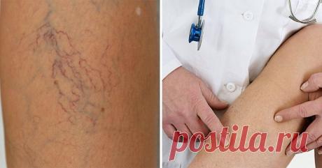 5 советов, которые помогут избавиться от сосудистых звездочек
Звездочки на ногах — головная боль большинства женщин. Звездочками принято называть сосудистые сеточки, которые выступают под кожей. Как правило, они имеют малиновый или фиолетовый оттенок. В итоге твои ножки уже не являются дорогами к счастью: брюк или длинные юбки, колготки потемнее, комплексы и неуверенность в себе. Обычно звездочки появляются в области лодыжек, икр и бедер. […]
Читай дальше на сайте. Жми подробнее ➡