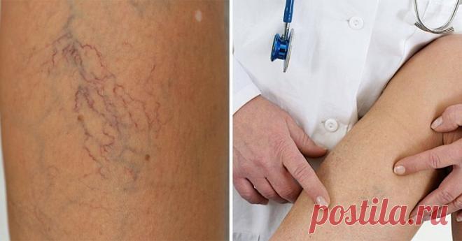 5 советов, которые помогут избавиться от сосудистых звездочек
Звездочки на ногах — головная боль большинства женщин. Звездочками принято называть сосудистые сеточки, которые выступают под кожей. Как правило, они имеют малиновый или фиолетовый оттенок. В итоге твои ножки уже не являются дорогами к счастью: брюк или длинные юбки, колготки потемнее, комплексы и неуверенность в себе. Обычно звездочки появляются в области лодыжек, икр и бедер. […]
Читай дальше на сайте. Жми подробнее ➡