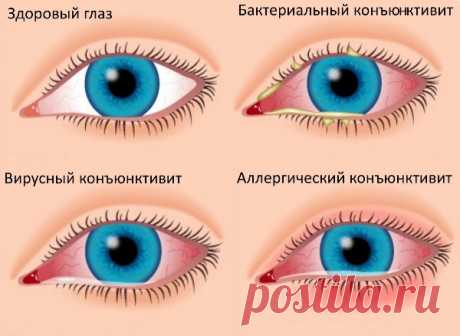 Конъюнктивит: лечение народными средствами