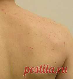 Прыщи на спине у подростка – причины и лечение - Сосед-Домосед