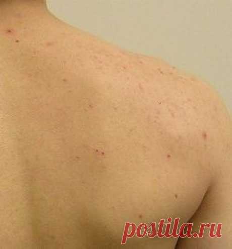 Прыщи на спине у подростка – причины и лечение - Сосед-Домосед
