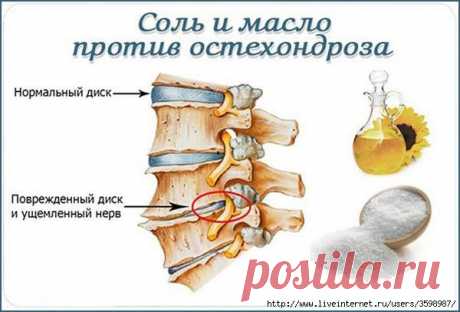 Соль и масло против остехондроза.