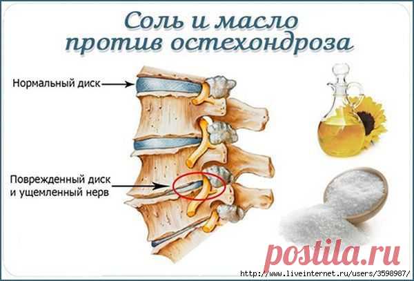 Соль и масло против остехондроза.