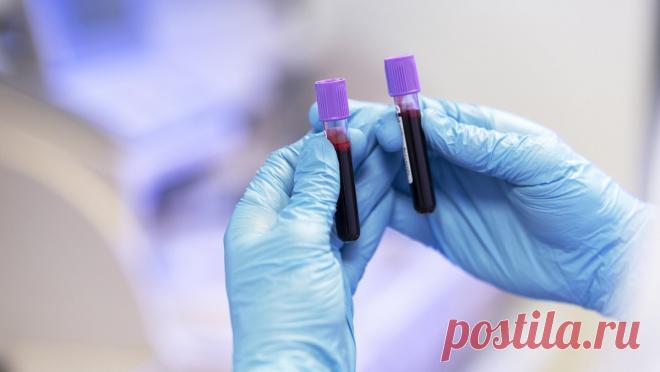 Врач развеяла популярный миф об общем анализе крови Daily Mirror: по общему анализу крови невозможно выявить рак.