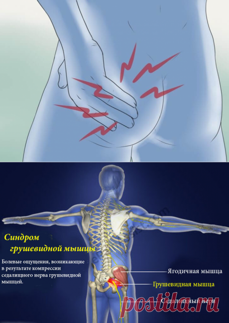 Синдром грушевидной мышцы: симптомы и упражнения