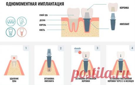 Всё, что вы должны знать об одномоментной имплантации зубов