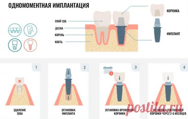 Всё, что вы должны знать об одномоментной имплантации зубов