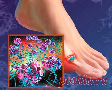 Что нужно знать про подагру / Будьте здоровы