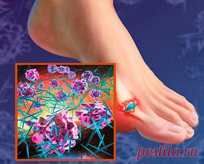 Что нужно знать про подагру / Будьте здоровы