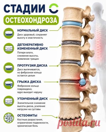 Стадии остеохондроза