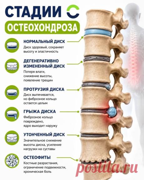Стадии остеохондроза