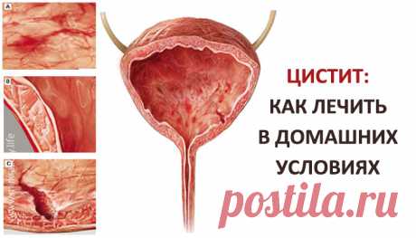 Лечение цистита у женщин: какие таблетки и травы помогут Самые эффективные препараты и всё, что нужно знать женщинам о цистите