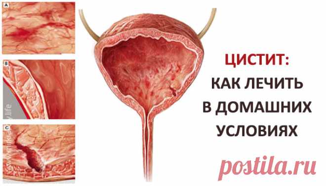 Лечение цистита у женщин: какие таблетки и травы помогут Самые эффективные препараты и всё, что нужно знать женщинам о цистите