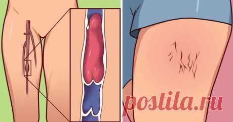 8 признаков, что у вас может быть тромб