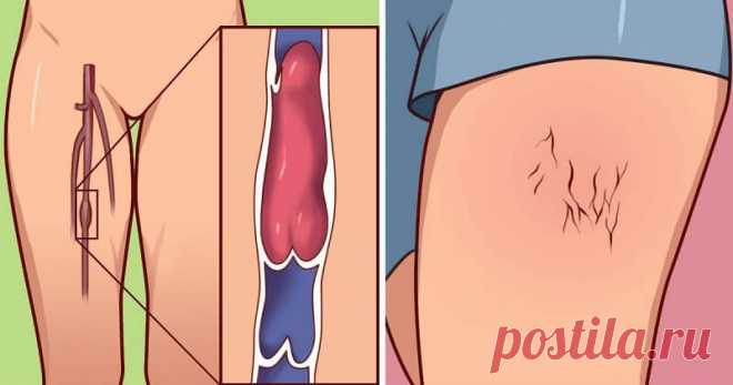 8 признаков, что у вас может быть тромб