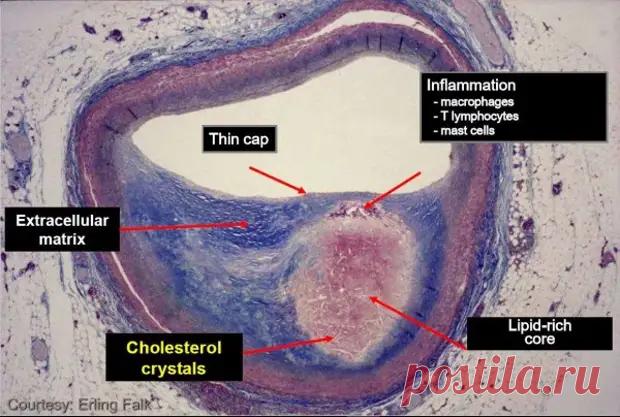 Как прожить без инфаркта и инсульта. Лекция врача Антона Родионова (+видео) - ПолонСил.ру - социальная сеть здоровья - медиаплатформа МирТесен
