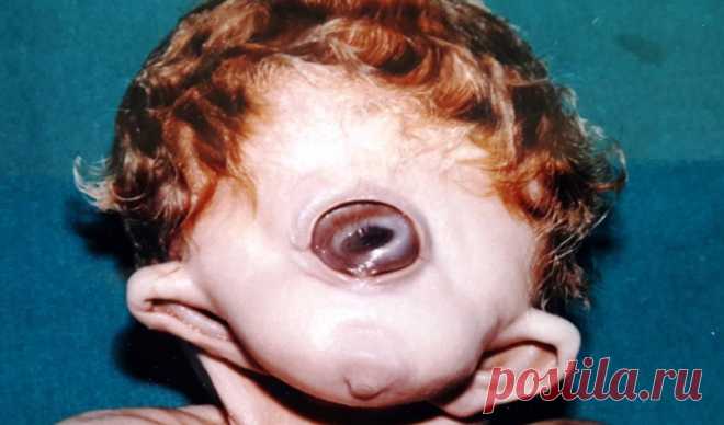 10 страшных и удивительных аномалий, которые преследуют человека .  ЦИКЛОПИЯ.