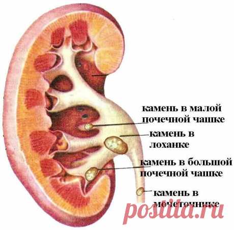 «Камни и песок в почках - симптомы и лечение. Откуда камни и песок в почках и мочевом пузыре, симптомы. Как очистить почки и мочевой пузырь от песка и камней. Методы лечения камней и песка в почках. Камни больших размеров удаляют хирургическим путем. Сюда же относится и литотрипсия дистанционная. С ее помощью дробят конкременты до мелких размеров. У процедуры есть свои нюансы, поскольку иногда страдают и органы от такого воздействия. Наиболее совре...