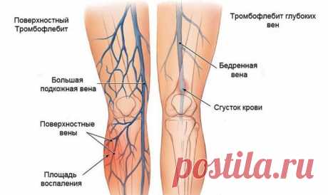 Тромбофлебит — исцеление без операции