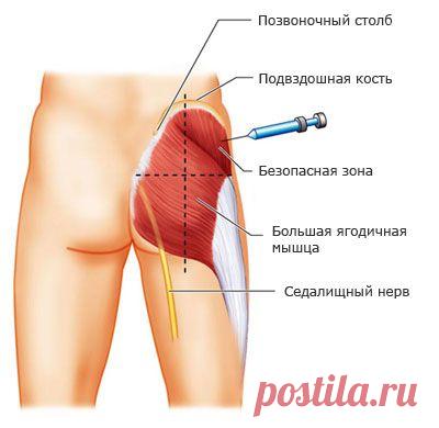 Внутримышечная инъекция в ягодицу: учимся делать самостоятельно — Делимся советами