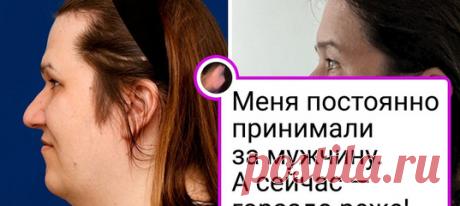 16 человек, которые рискнули сделать ринопластику и перестали ненавидеть свой профиль