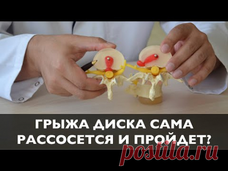 Лечение грыжи без операции | Резорбция грыжи | Корешковый синдром | Грыжа диска рассасывается?