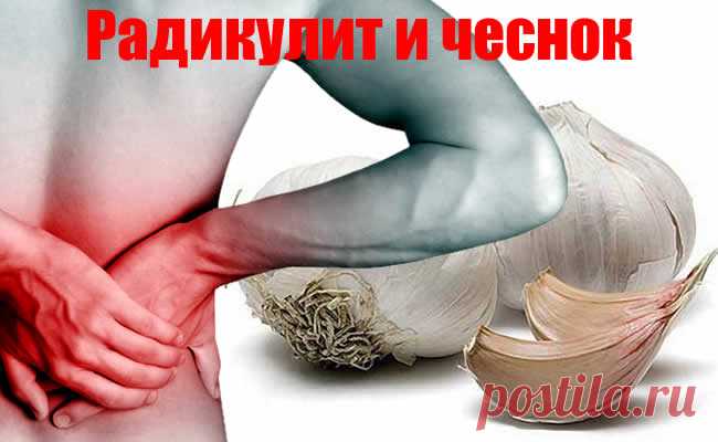 Радикулит. Чеснок, как лучший и быстрейший исцелитель от приступа радикулита.