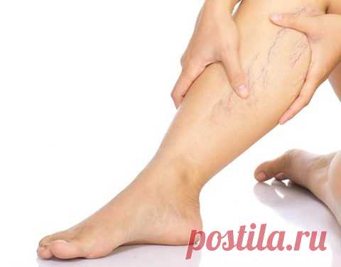 В каком случае нужно немедленно лечить варикоз? / Будьте здоровы