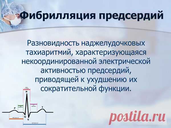 Катетерная абляция фибрилляции предсердий - что это такое, возможные осложнения