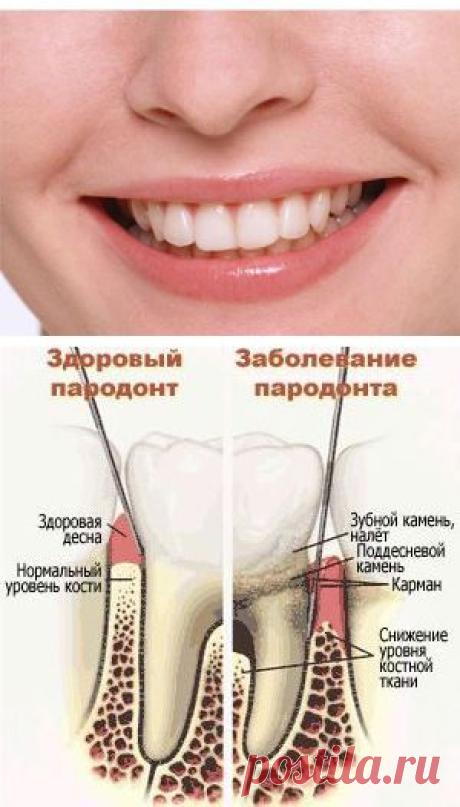 Лечение пародонтита травами / Будьте здоровы