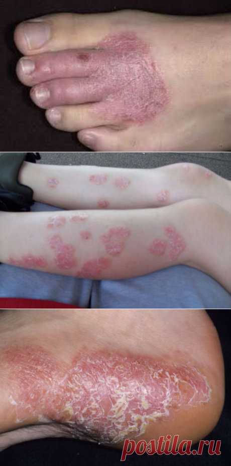 Лечение псориаза на ногах, формы, симптомы, фото