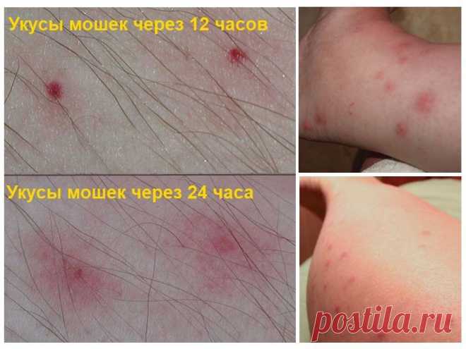 Укус мошки на фото: как выглядит, чем лечить, снять отек и зуд