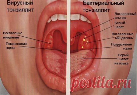 ЧИСТИМ МИНДАЛИНЫ И НЕ БОЛЕЕМ. | Познавательный сайт ,,1000 мелочей"