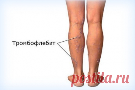 Домашнее лечение тромбофлебита — Здоровое Долголетие