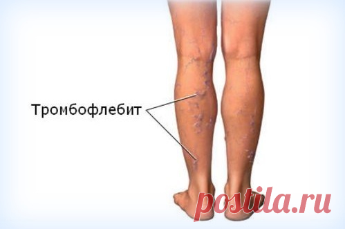 Домашнее лечение тромбофлебита — Здоровое Долголетие