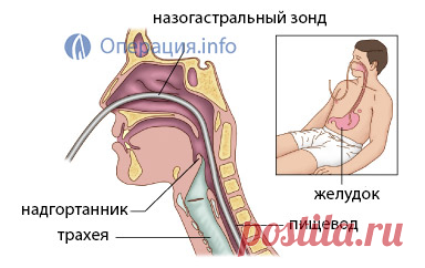 Назогастральный зонд: постановка, кормление, уход