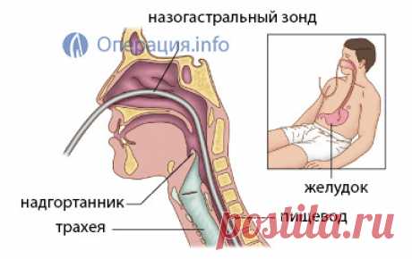 Назогастральный зонд: постановка, кормление, уход