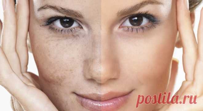 Что нужно знать о пигментных пятнах | Делимся советами